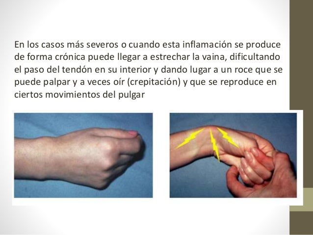 enfermedad de quervain